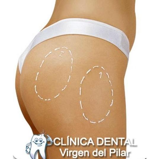 Liposucción: Tratamientos de Clínica Dental Virgen del Pilar Liposucción: Tratamientos de Clínica Dental Virgen del Pilar