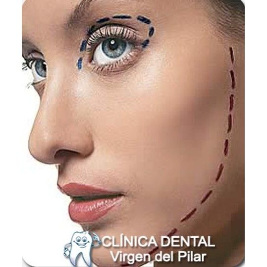Lifting: Tratamientos de Clínica Dental Virgen del Pilar Lifting: Tratamientos de Clínica Dental Virgen del Pilar