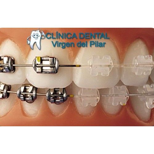 Ortodoncia: Tratamientos de Clínica Dental Virgen del Pilar Ortodoncia: Tratamientos de Clínica Dental Virgen del Pilar