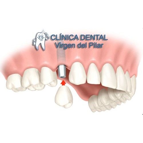 Prótesis dental: Tratamientos de Clínica Dental Virgen del Pilar Prótesis dental: Tratamientos de Clínica Dental Virgen del Pilar