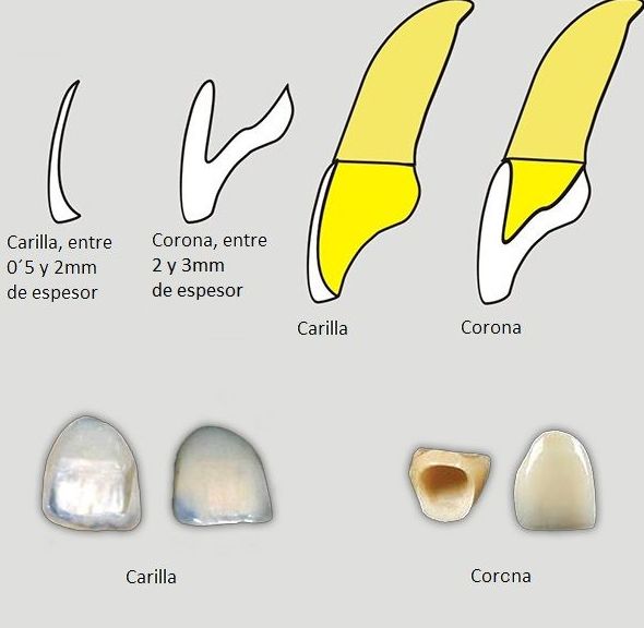Diferencias entre carilla y corona Diferencias entre carilla y corona