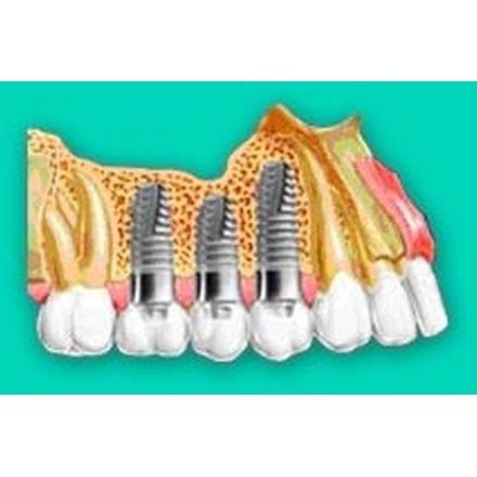 Implantología: Tratamientos de Clínica Dental Miquel Mayordomo Implantología: Tratamientos de Clínica Dental Miquel Mayordomo