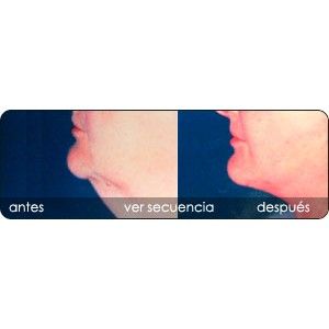 Rejuvenecimiento de cejas y frente: Servicios de Clínica Dr. Javier Cerqueiro Cirugía Plástica Rejuvenecimiento de cejas y frente: Servicios de Clínica Dr. Javier Cerqueiro Cirugía Plástica