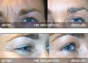 Tratamiento de arrugas con toxina botulínica : Servicios de Clínica Dr. Javier Cerqueiro Cirugía Plástica Tratamiento de arrugas con toxina botulínica : Servicios de Clínica Dr. Javier Cerqueiro Cirugía Plástica