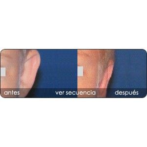 Corrección de Orejas prominentes: Servicios de Clínica Dr. Javier Cerqueiro Cirugía Plástica Corrección de Orejas prominentes: Servicios de Clínica Dr. Javier Cerqueiro Cirugía Plástica