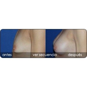 Aumento mamario: Servicios de Clínica Dr. Javier Cerqueiro Cirugía Plástica Aumento mamario: Servicios de Clínica Dr. Javier Cerqueiro Cirugía Plástica