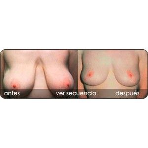 Reducción mamaria: Servicios de Clínica Dr. Javier Cerqueiro Cirugía Plástica Reducción mamaria: Servicios de Clínica Dr. Javier Cerqueiro Cirugía Plástica