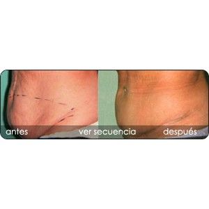Reducción de abdomen: Servicios de Clínica Dr. Javier Cerqueiro Cirugía Plástica Reducción de abdomen: Servicios de Clínica Dr. Javier Cerqueiro Cirugía Plástica