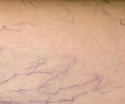 Escleroterapia. Tratamiento de vénulas: Servicios de Clínica Dr. Javier Cerqueiro Cirugía Plástica Escleroterapia. Tratamiento de vénulas: Servicios de Clínica Dr. Javier Cerqueiro Cirugía Plástica