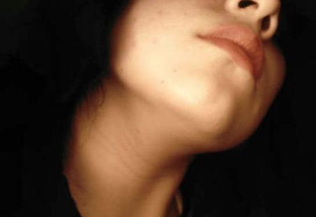 Lifting cervical (cuello): Servicios de Clínica Dr. Javier Cerqueiro Cirugía Plástica Lifting cervical (cuello): Servicios de Clínica Dr. Javier Cerqueiro Cirugía Plástica