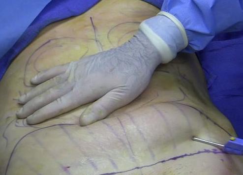Liposucción en el paciente varón: Servicios de Clínica Dr. Javier Cerqueiro Cirugía Plástica Liposucción en el paciente varón: Servicios de Clínica Dr. Javier Cerqueiro Cirugía Plástica
