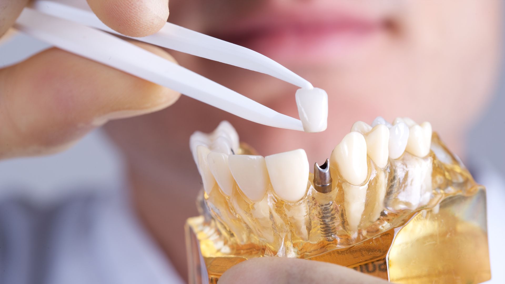 Implantes dentales en Las Palmas de Gran Canarias