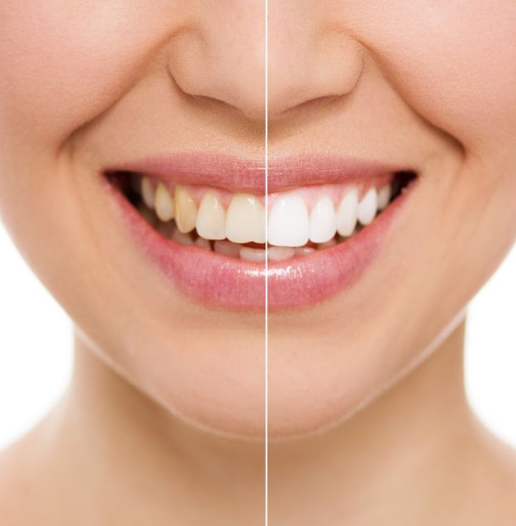 Blanqueamiento dental: Especialidades de Clínica Dental López Rodrigo Blanqueamiento dental: Especialidades de Clínica Dental López Rodrigo