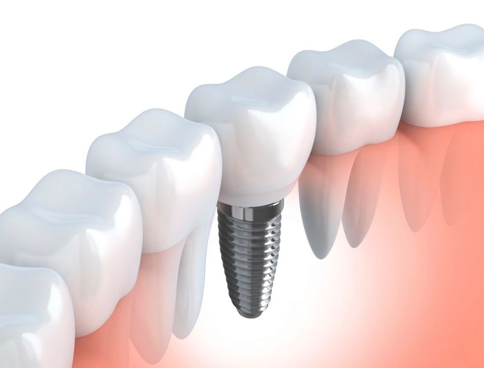 Implantes dentales: Especialidades de Clínica Dental López Rodrigo Implantes dentales: Especialidades de Clínica Dental López Rodrigo