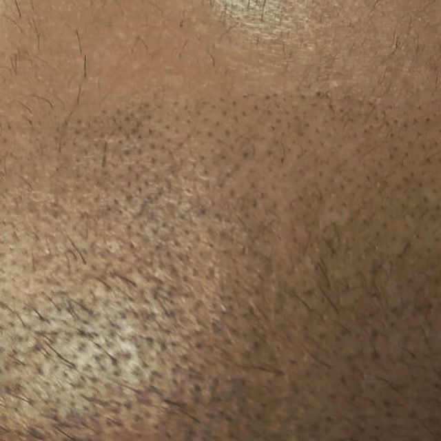 Tricopigmentación: ¿Qué hacemos? de Marca Sacra Tattoo Studio Tricopigmentación: ¿Qué hacemos? de Marca Sacra Tattoo Studio