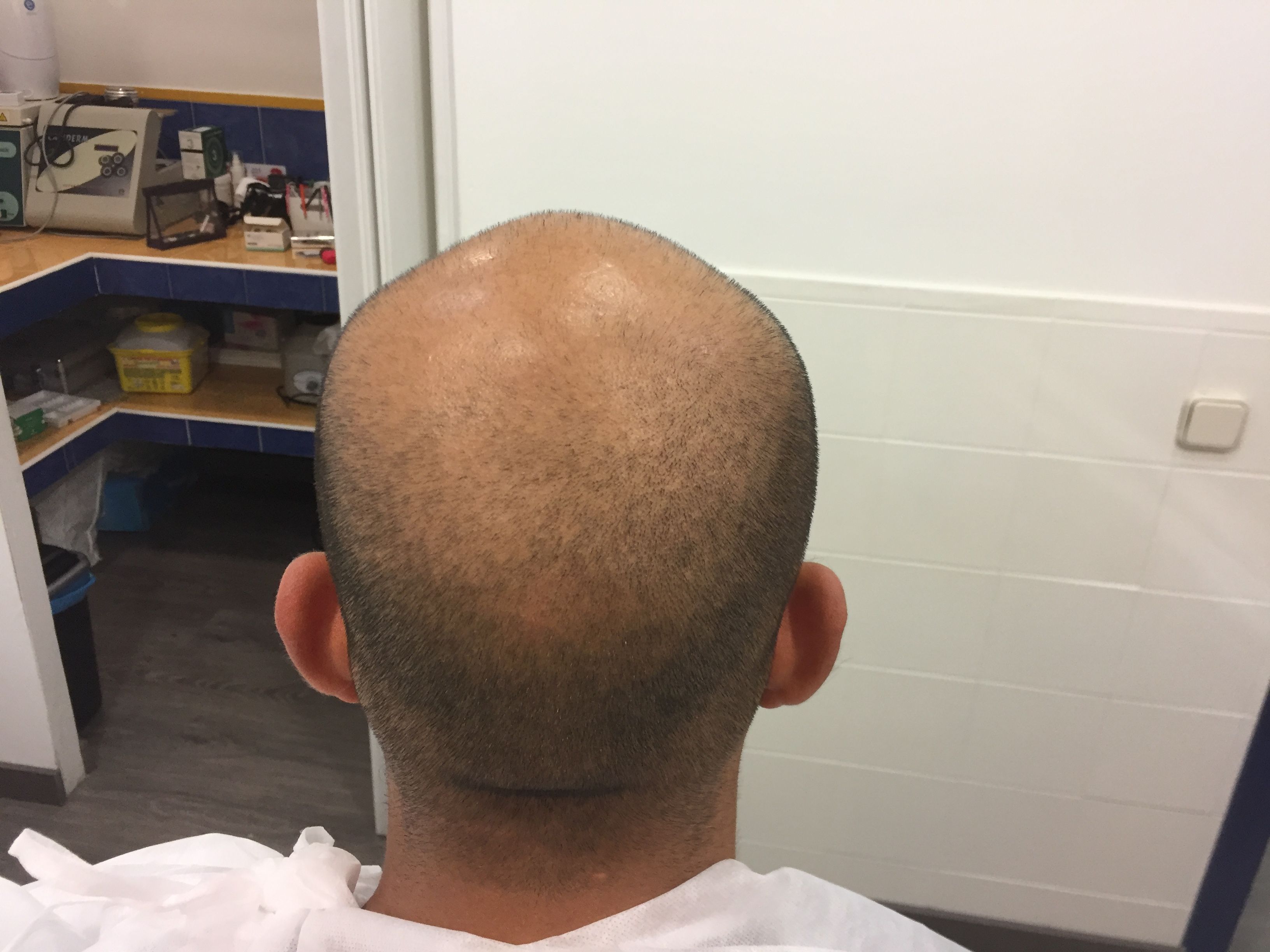 Tricopigmentación: ¿Qué hacemos? de Marca Sacra Tattoo Studio Tricopigmentación: ¿Qué hacemos? de Marca Sacra Tattoo Studio