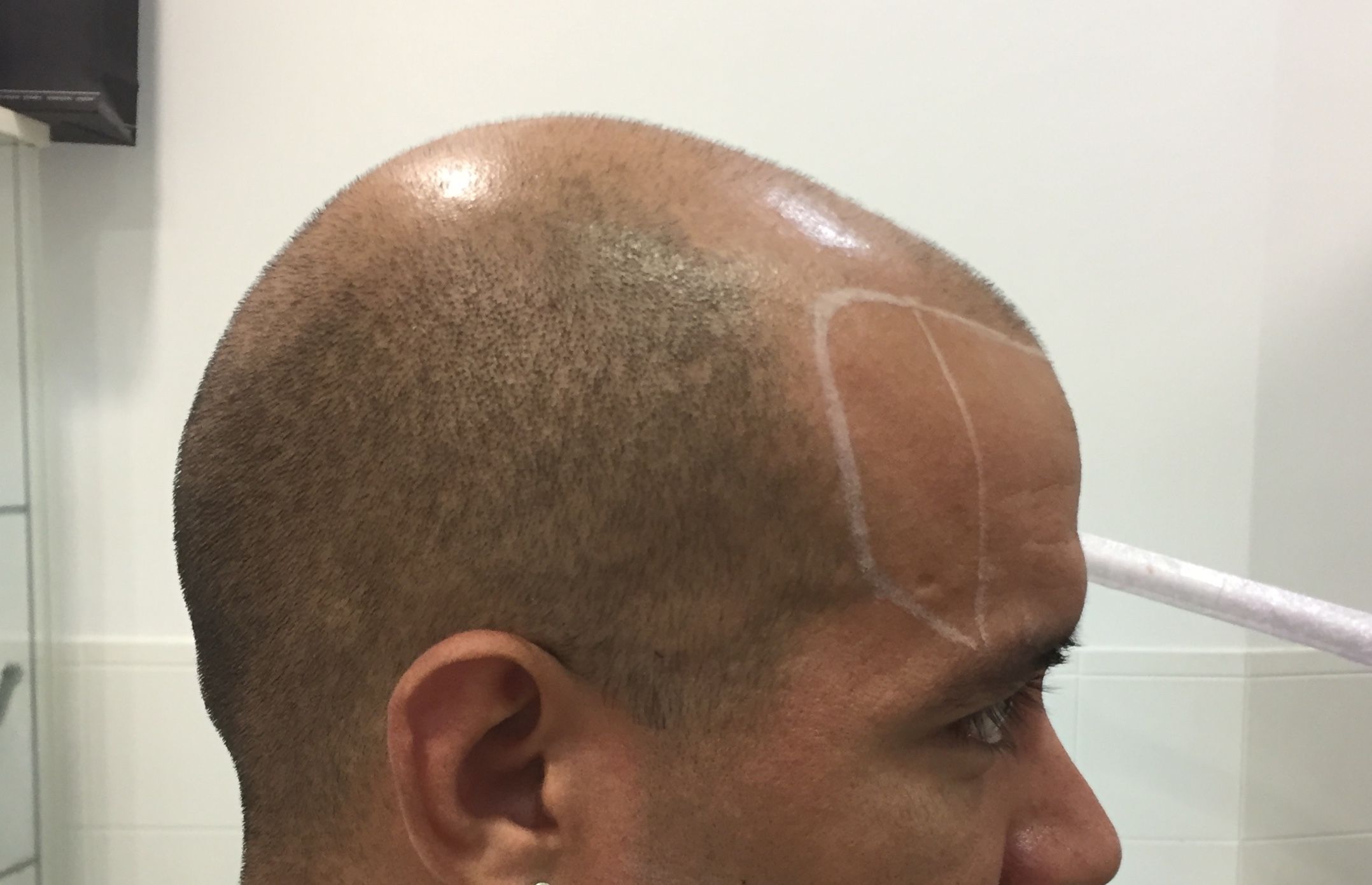 Tricopigmentación: ¿Qué hacemos? de Marca Sacra Tattoo Studio Tricopigmentación: ¿Qué hacemos? de Marca Sacra Tattoo Studio