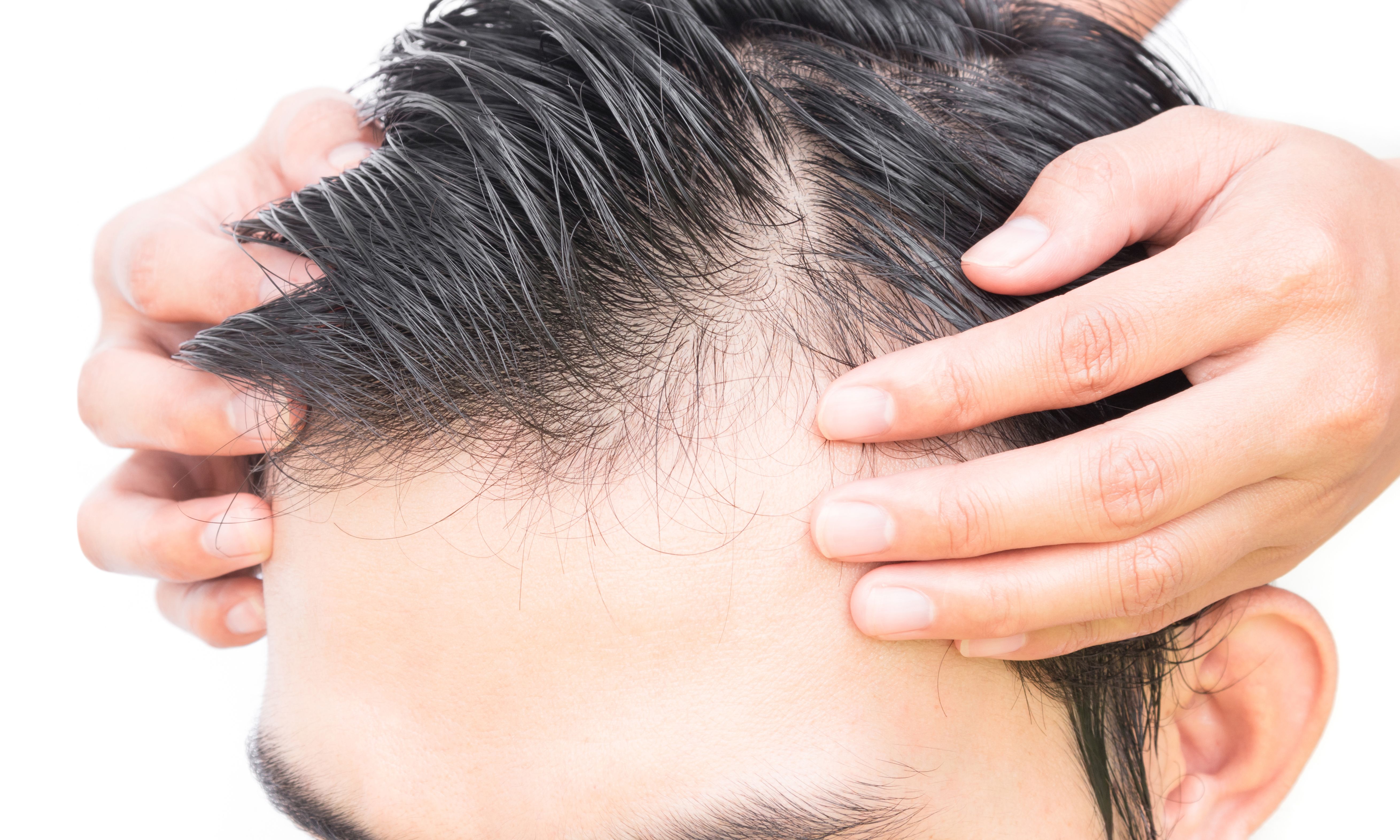 Alopecia areata: Products de SG Centros capilares y Estética Alopecia areata: Products de SG Centros capilares y Estética
