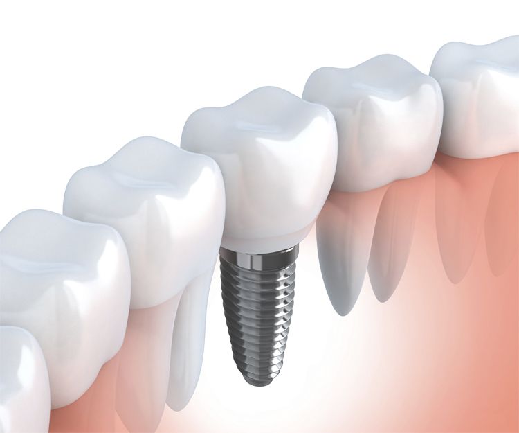 Implantes dentales en Palencia
