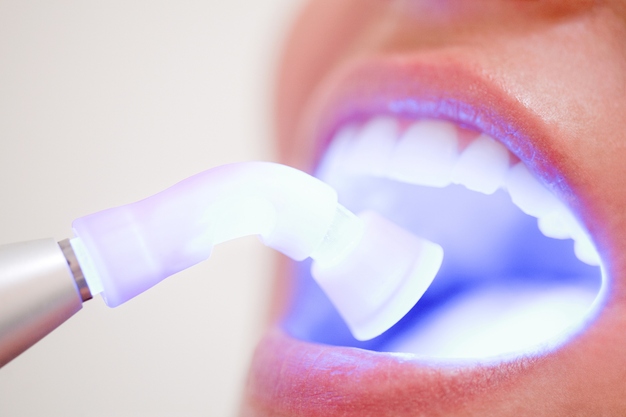 Blanqueamiento: Tratamientos de Clínica Dental Del Valle Blanqueamiento: Tratamientos de Clínica Dental Del Valle