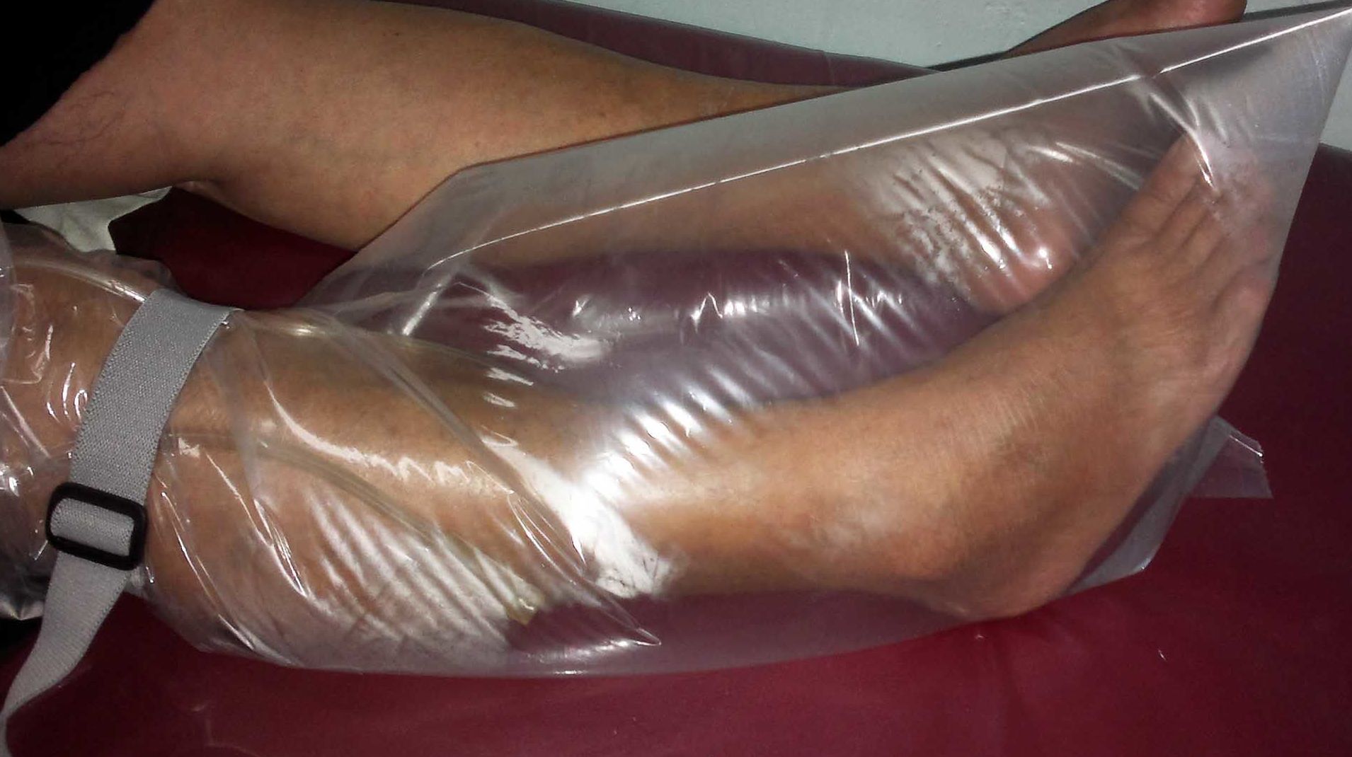 Ozonoterapia médica: Servicios y Tratamientos de Neodermal Malaga Ozonoterapia médica: Servicios y Tratamientos de Neodermal Malaga