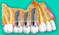Implantes : Especialidades de Insadent - Centro Odontológico Implantes : Especialidades de Insadent - Centro Odontológico
