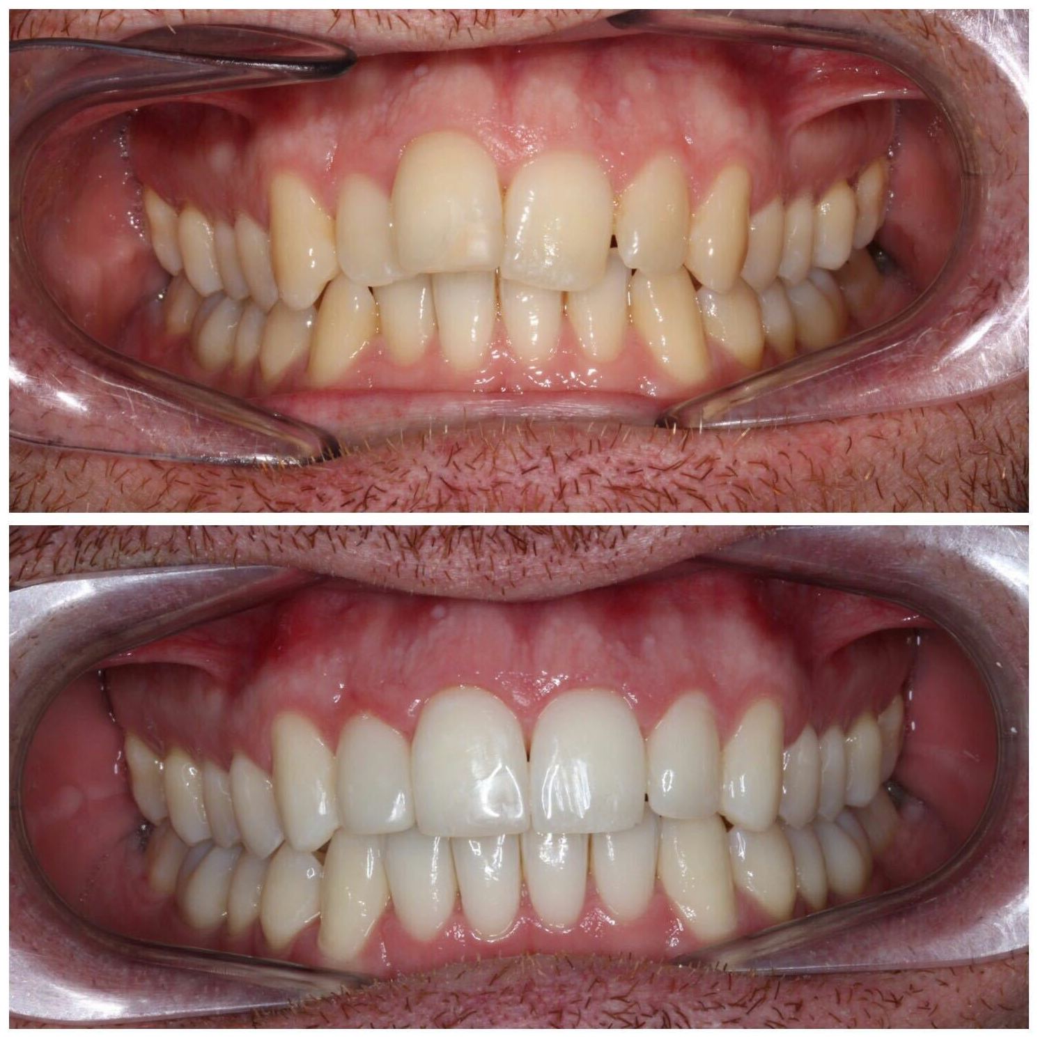 Blanqueamiento dental en Sabadell Blanqueamiento dental en Sabadell