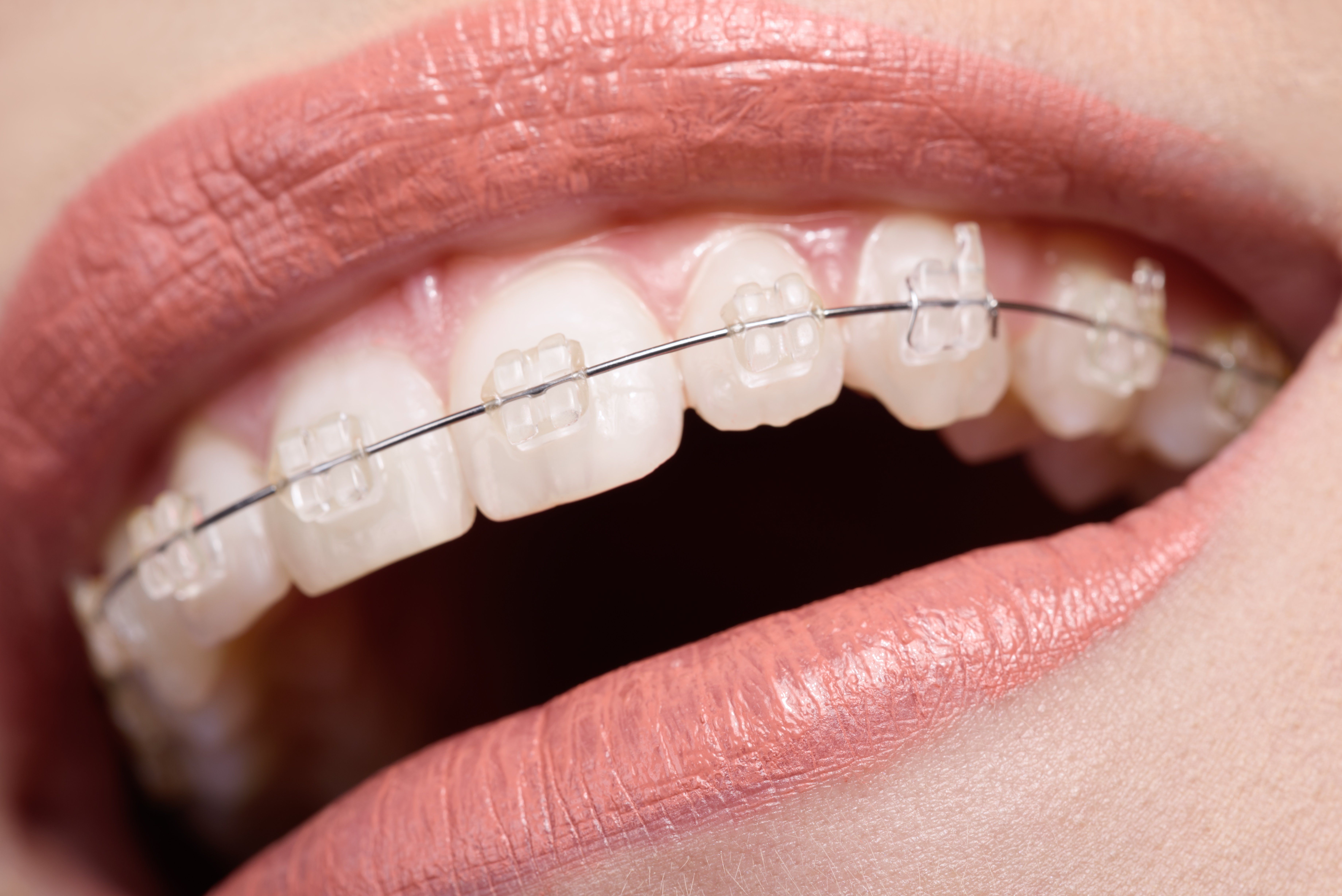 Ortodoncias correctivas: Servicios de Clínica Dental Mataró Ortodoncias correctivas: Servicios de Clínica Dental Mataró