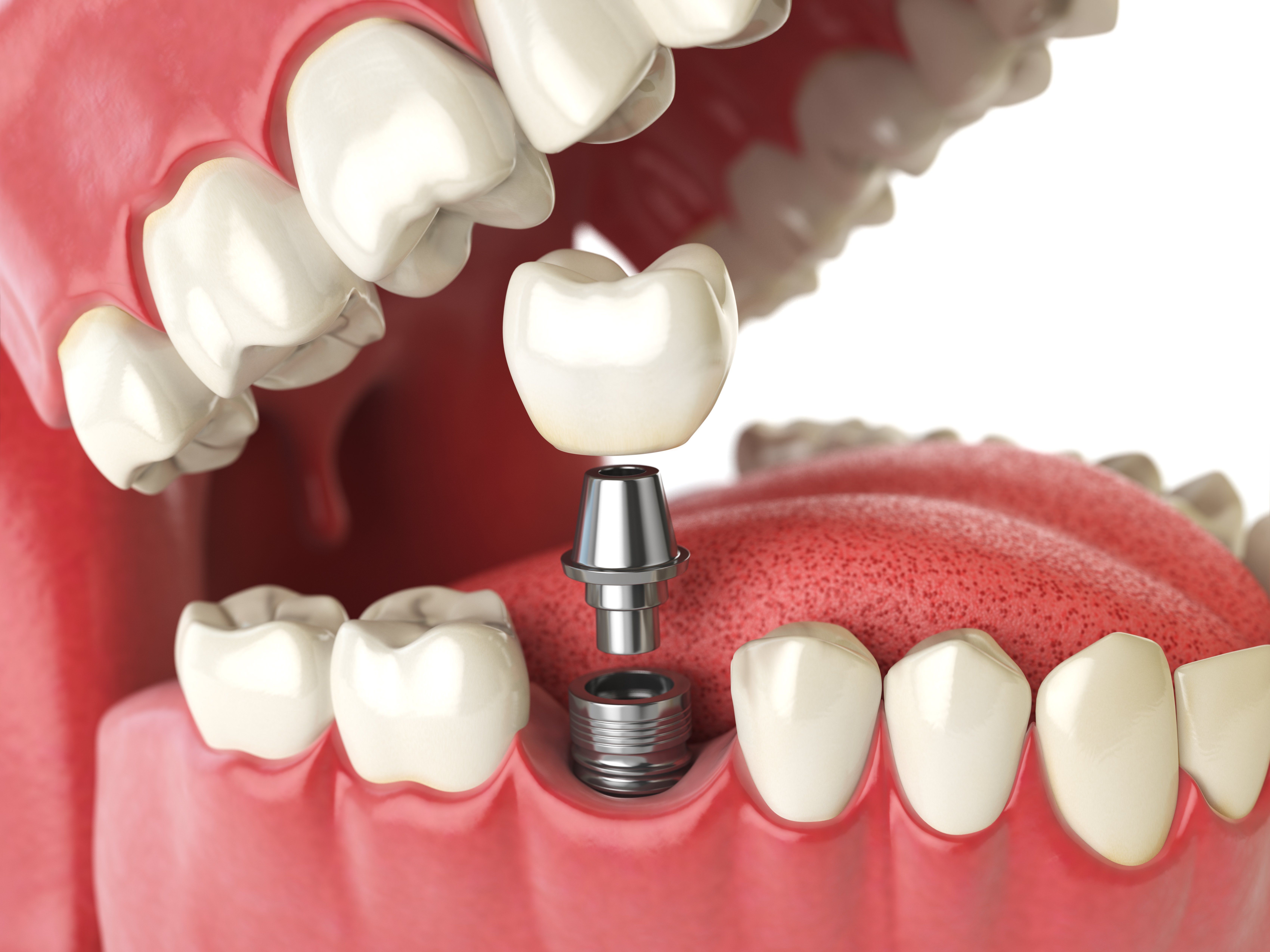 Implantes dentales: Servicios de Clínica Dental Mataró Implantes dentales: Servicios de Clínica Dental Mataró
