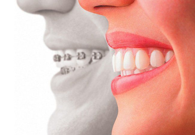 Ortodoncias correctivas: Servicios de Clínica Dental Mataró Ortodoncias correctivas: Servicios de Clínica Dental Mataró