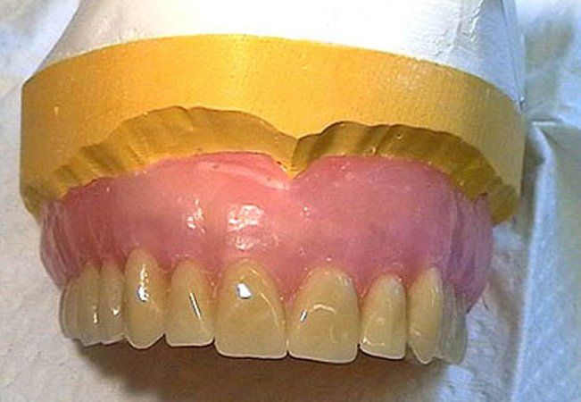 Prótesis dentales: Servicios de Clínica Dental Mataró Prótesis dentales: Servicios de Clínica Dental Mataró