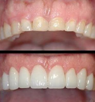 Implantes cigomáticos: Tratamientos de Suavilaser Implantes cigomáticos: Tratamientos de Suavilaser