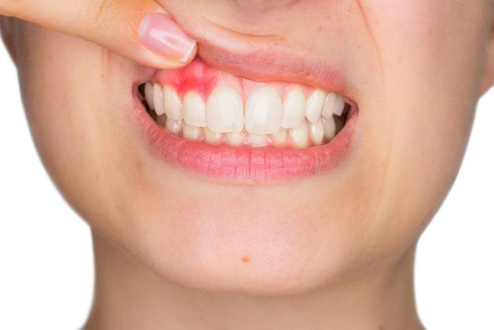Periodoncia: Tratamientos de Suavilaser Periodoncia: Tratamientos de Suavilaser
