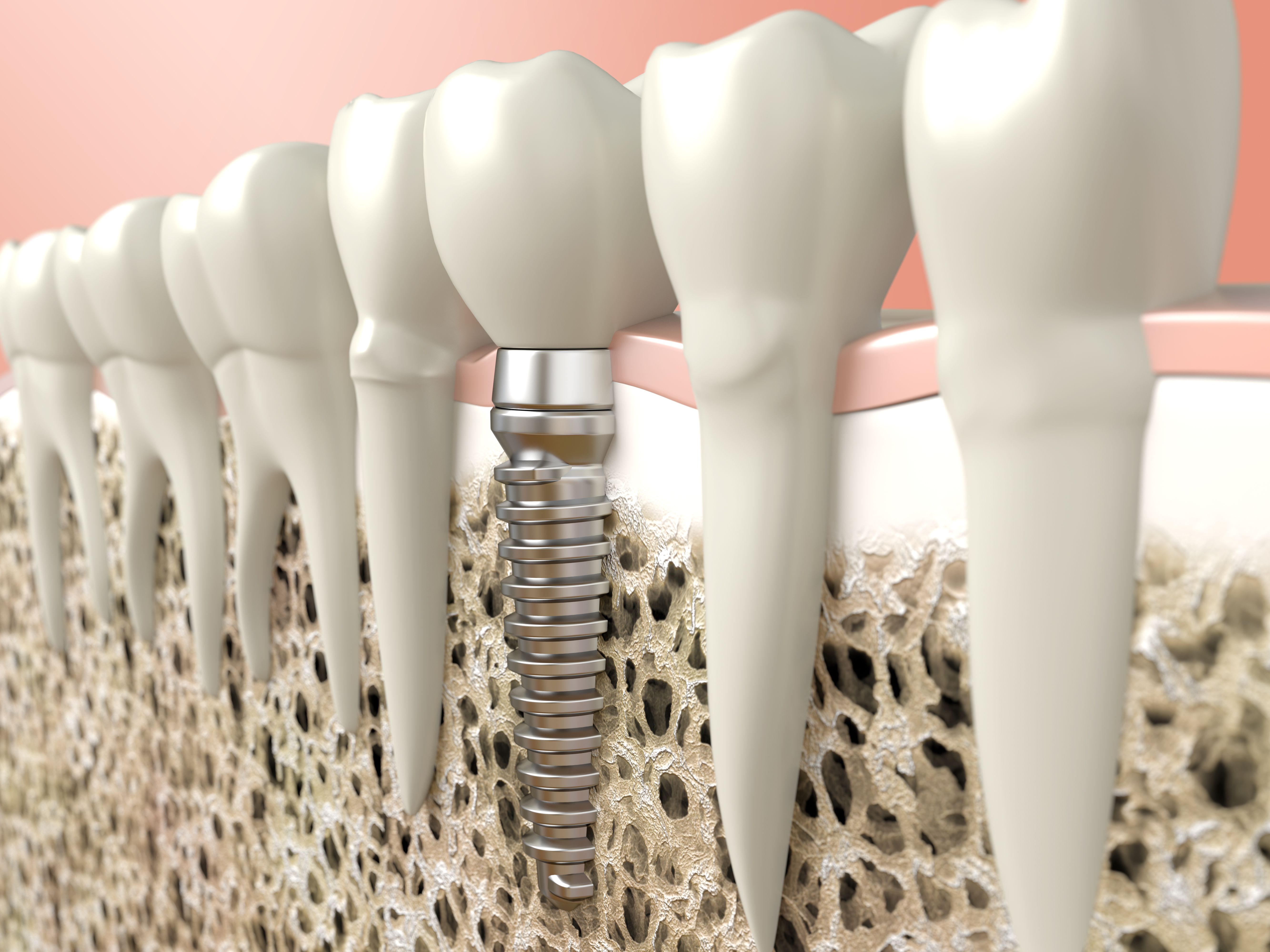Implantología: Tratamientos de Suavilaser Implantología: Tratamientos de Suavilaser
