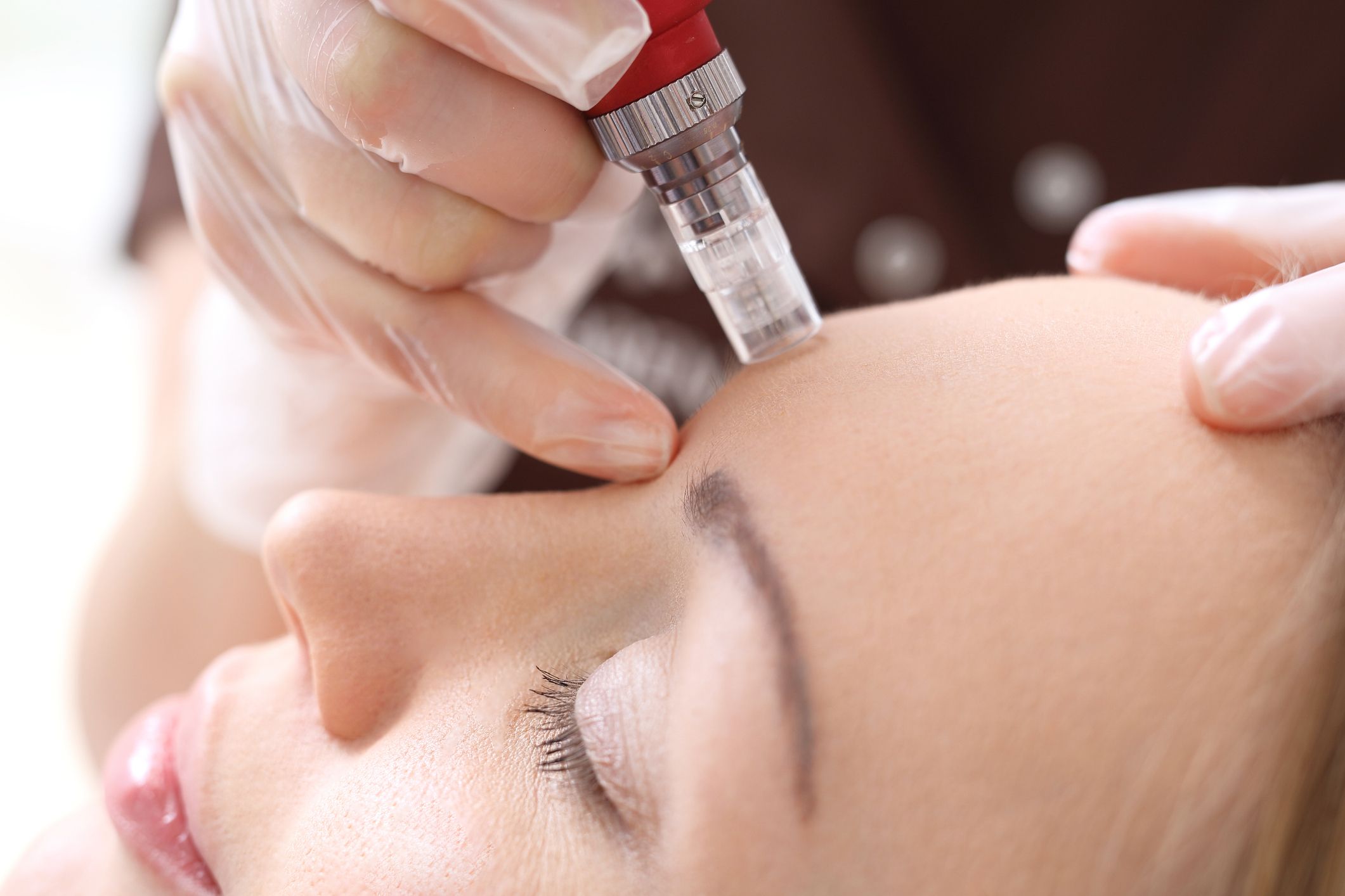 Dermapen: Tratamientos de Clínica Dra. Darinka Garay Dermapen: Tratamientos de Clínica Dra. Darinka Garay