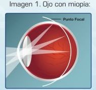 Miopía: Catálogo de Visual Tegueste Ópticos Miopía: Catálogo de Visual Tegueste Ópticos