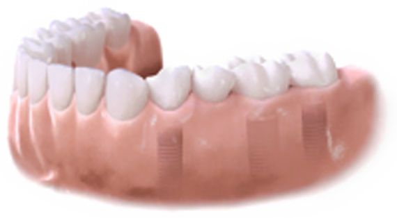 Implantes dentales en León