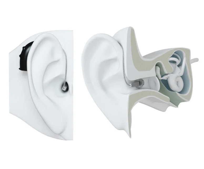 Auricular Intracanal (RIC): Servicios de Centro Auditivo Oe Auricular Intracanal (RIC): Servicios de Centro Auditivo Oe