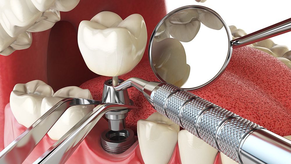 Implantología: Tratamientos de Clínica dental Vall Hebrón