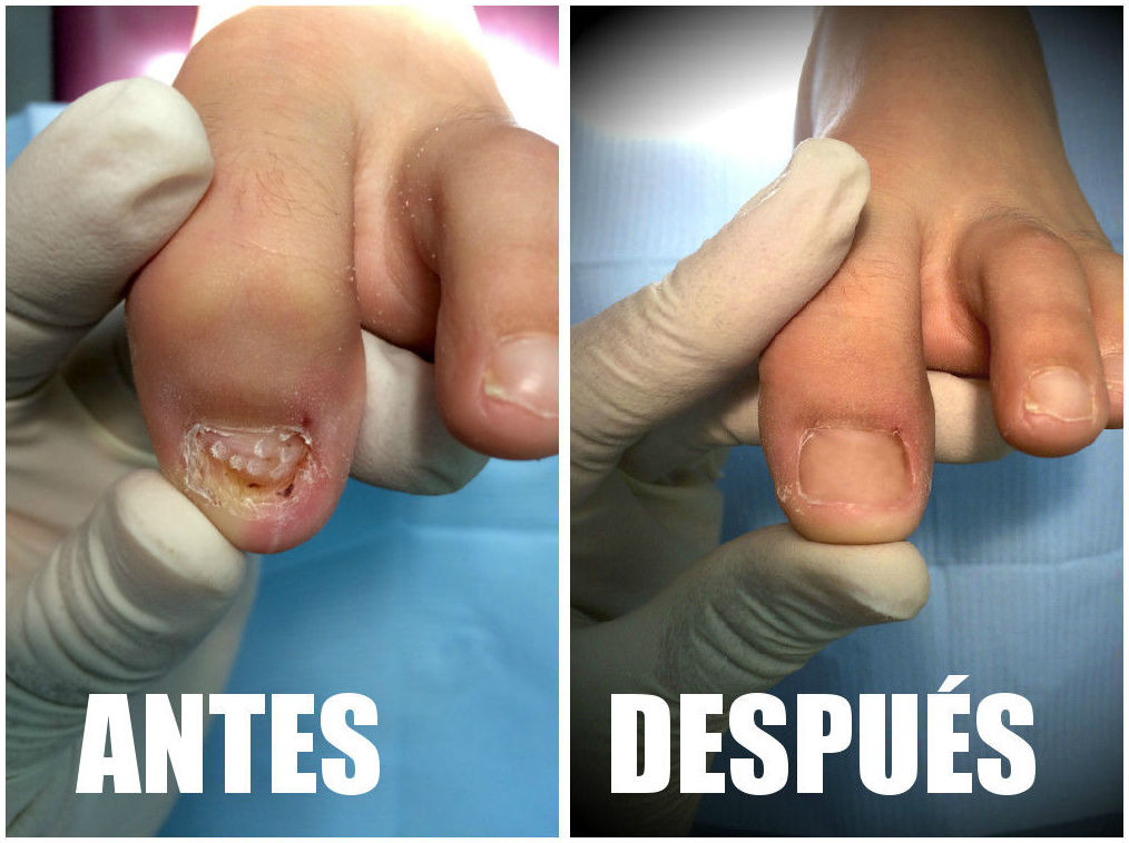 Reconstrucción de uñas Reconstrucción de uñas
