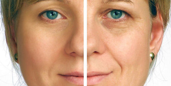 Dermoabrasión facial Dermoabrasión facial