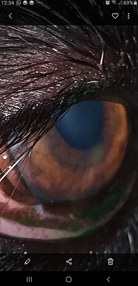 Úlcera en un ojo. Úlcera en un ojo.