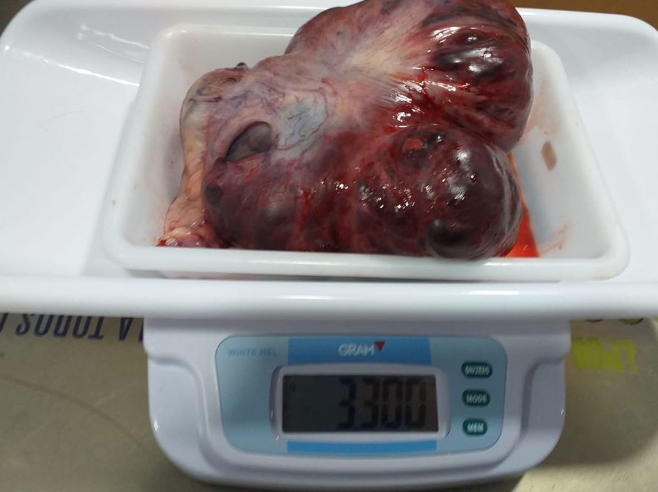 Cáncer de útero Cáncer de útero