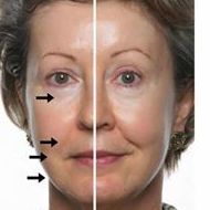 FACIAL PLASMA FACIAL PLASMA