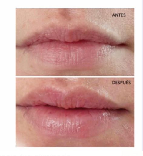 Relleno de labios Hyalu-in: Servicios de Divinity Body Nails Relleno de labios Hyalu-in: Servicios de Divinity Body Nails