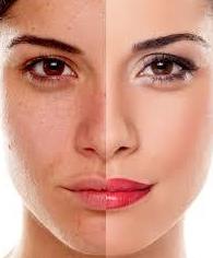 TRAT. DE ACNE PIELES JOVENES: Servicios de Divinity Body Nails TRAT. DE ACNE PIELES JOVENES: Servicios de Divinity Body Nails