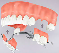 Pròtesis fixes / extraïbles: Catàleg de Bukalix Pròtesis fixes / extraïbles: Catàleg de Bukalix