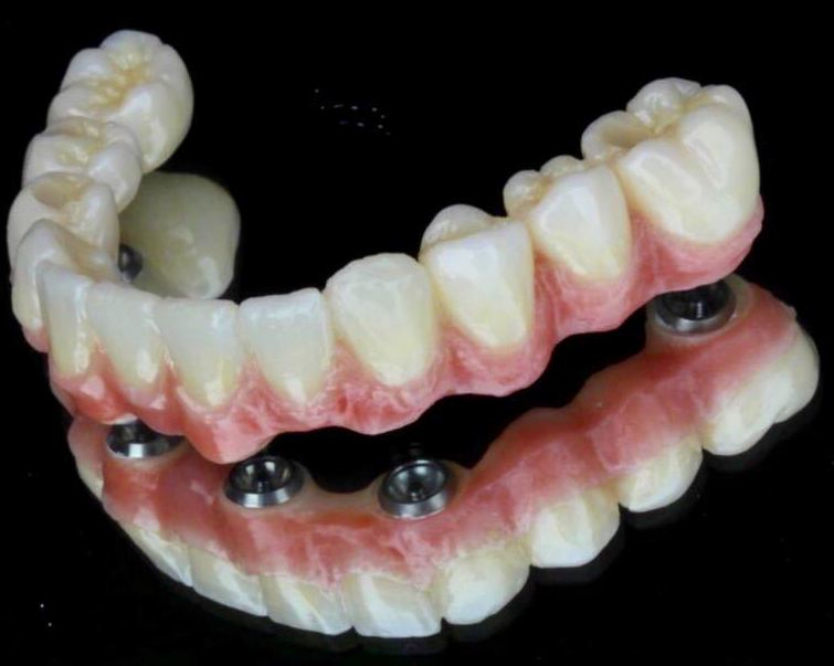 Implants dentals: Catàleg de Bukalix Implants dentals: Catàleg de Bukalix