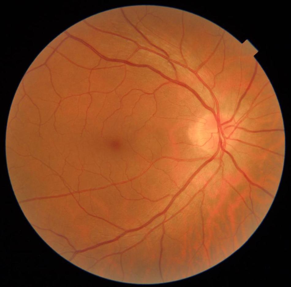 Retina sana vista por el retinografo de Optica esplugues Retina sana vista por el retinografo de Optica esplugues