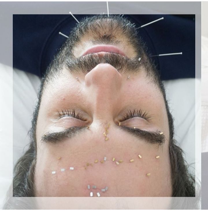 Acupuntura facial Acupuntura facial